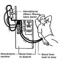 Diagram of how a hemodialysis

machine works.