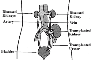Diagram of
how a kidney transplant works.